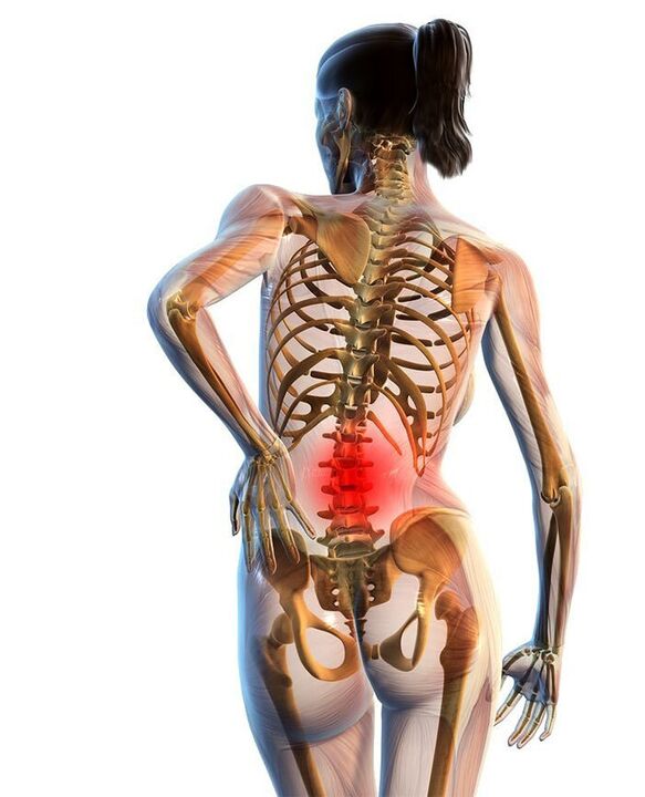 A osteocondrose da coluna lombar ocorre com mais frequência