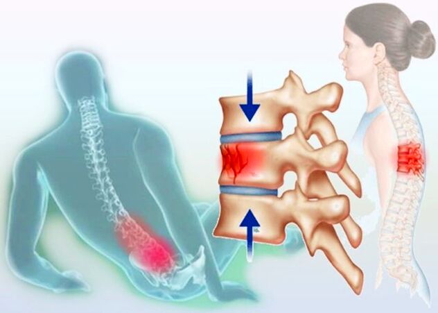 Mesmo uma lesão comum pode desencadear o desenvolvimento de osteocondrose