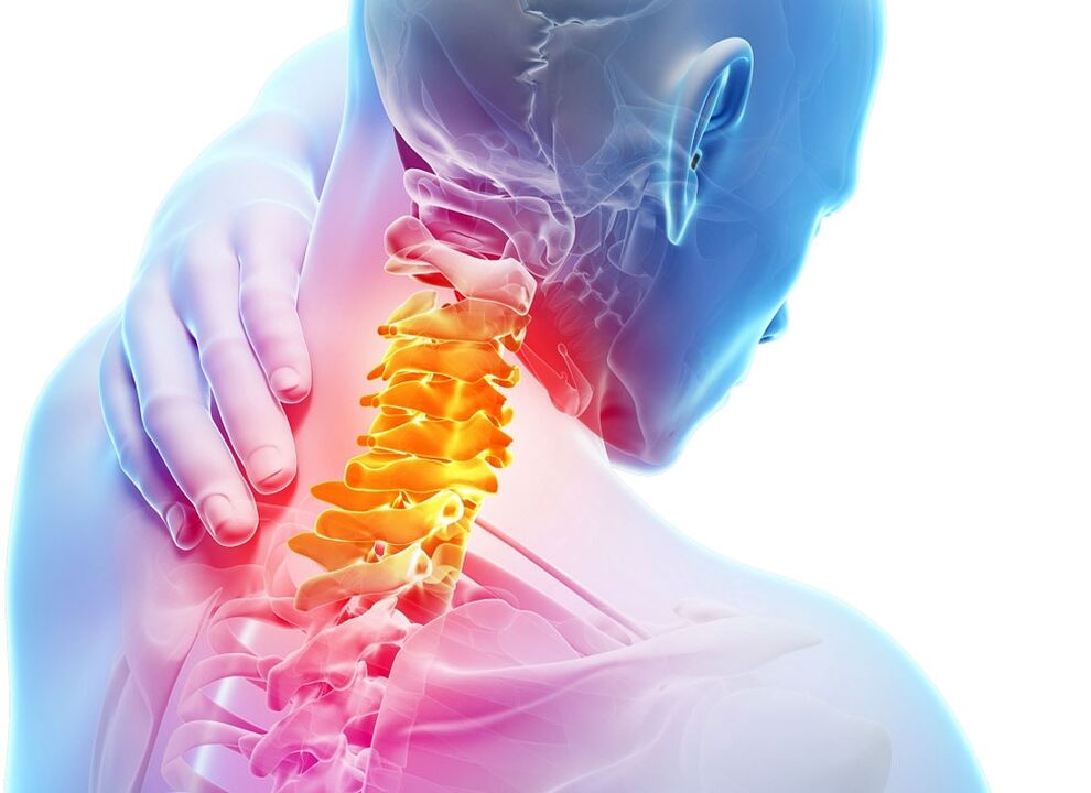 sintomas de osteocondrose cervical