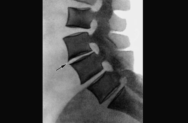 Manifestações de osteocondrose da coluna torácica em uma radiografia